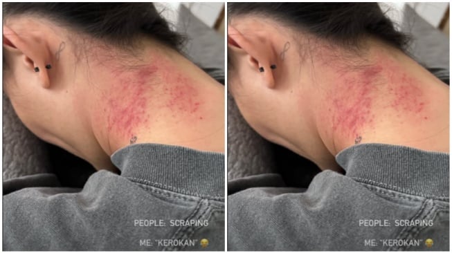 Agnez Mo pamer leher sehabis kerokan (Instagram)