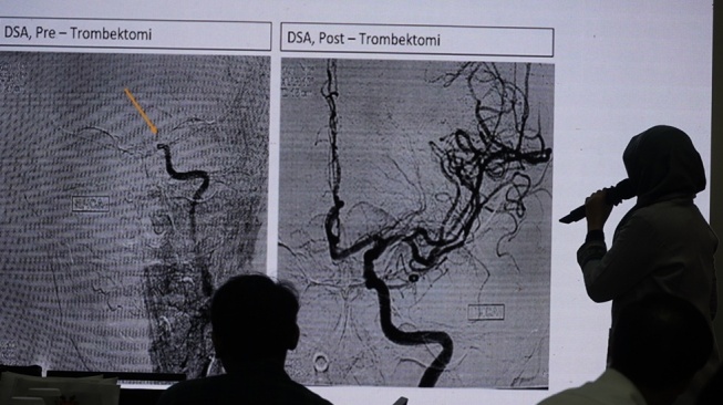 Dont Miss a Beat: Setiap Menit Berharga untuk Menyelamatkan Nyawa Pasien Aritmia dan Stroke
