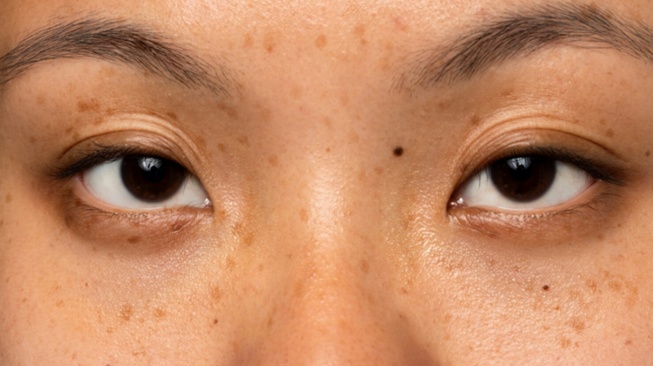 Ilustrasi wanita memiliki flek hitam (Freepik)