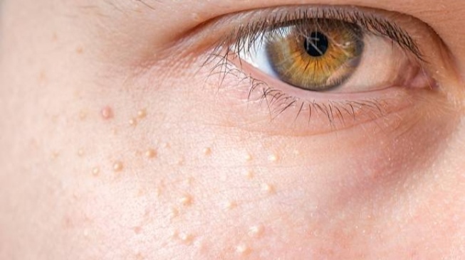 5 Rekomendasi Exfoliating Toner untuk Milia: Hemat dan Aman, Jadikan Kulit Mulus Kembali