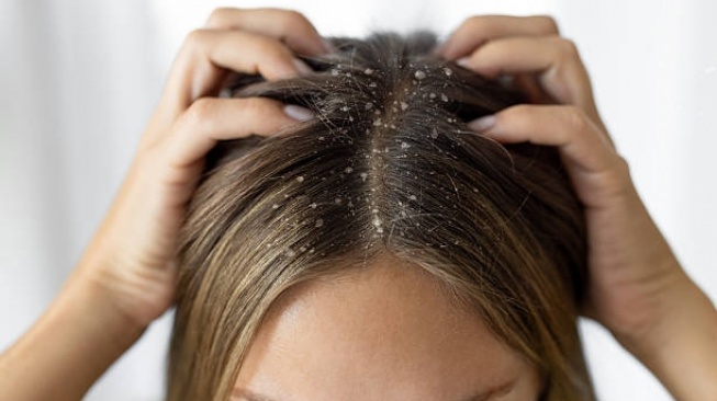 5 Rekomendasi Sampo Terbaik untuk Kulit Kepala Dermatitis Seboroik