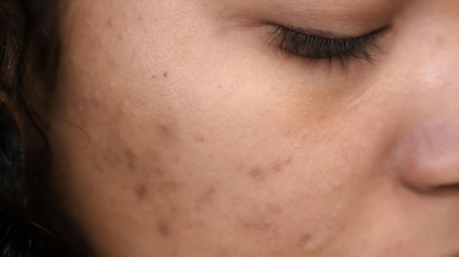 Bekas Jerawat Membandel? Coba 4 Cara Alami Ini, Bahannya Mudah Didapat