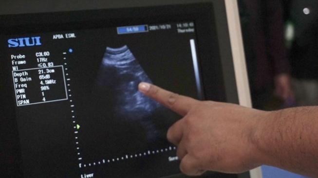 Selang Urine Tertinggal di Ginjal Pasien, Dokter RS Borromeus Divonis Langgar Disiplin