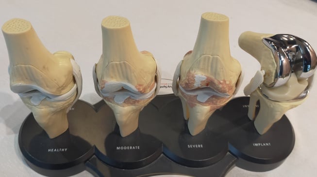 Contoh struktur tulang lutut yang mendapatkan tindakan operasi. dr. Ricky Hutapea, SpOT (K) Hip & Knee menjelaskan, pasien yang menjalani operasi Advance Total Knee Replacement berusia di atas 50 tahun dan robot melakukan proses "copy dan paste" kondisi tulang pasien (Suara.com/CNR ukirsari)