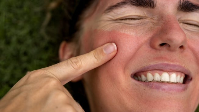 4 Rekomendasi Toner untuk Meredakan Kulit Sunburn akibat Paparan Matahari