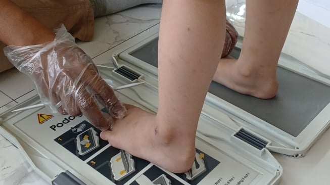 Telapak Kaki Datar pada Anak, Normal atau Perlu Diperiksa?