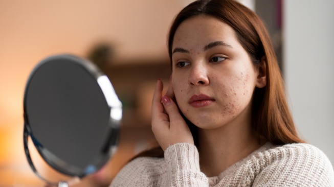 7 Rekomendasi Serum Penghilang Bekas Jerawat, Bikin Kulit Cerah Merata