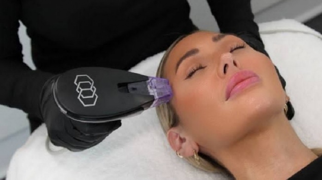 Kulit Kencang Tanpa Bedah? Bongkar Cara Kerja Morpheus8 Brust untuk Dagu hingga Paha!