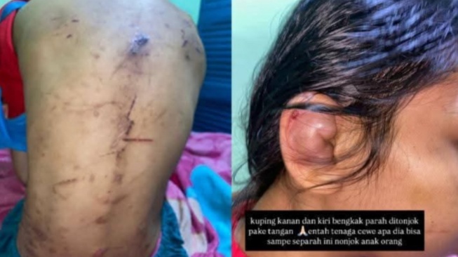 ART Diduga Disiksa ASN BPK di Gunung Putri, Kapolres: Hari Ini Gelar Perkara Penetapan Tersangka