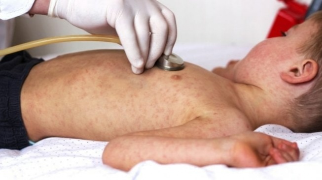 Waspada! 5 Gejala Awal Campak pada Bayi yang Sering Dikira Cuma Flu Biasa