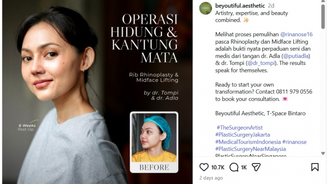 Rina Nose lakukan oplas [Instagram]