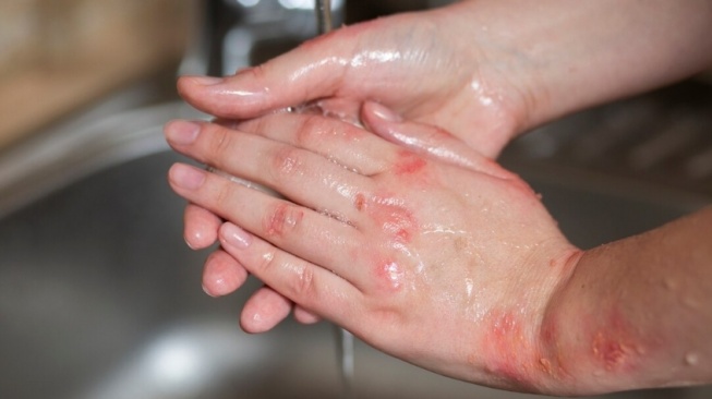 4 Langkah Pertolongan Pertama Jika Kena Air Keras, Antisipasi dari Kasus Andrie Yunus