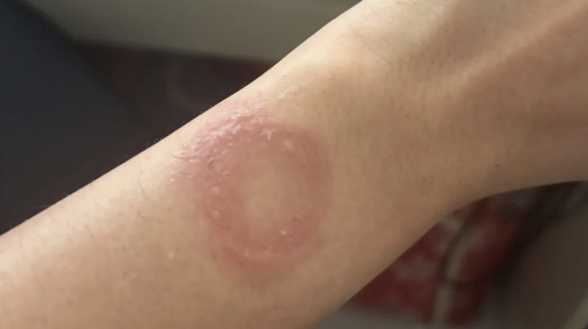 Diduga akibat Apple Watch yang terlalu panas. [Reddit]