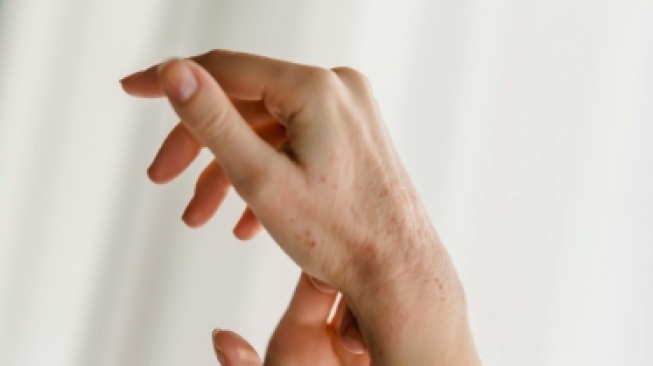 Kabar Duka Dokter Muda Tewas Akibat Campak: Bukan Sekadar Penyakit Anak-Anak!