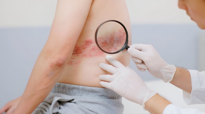 Cacar Api Mengintai Diam-Diam: Kelompok Rentan Bisa Alami Komplikasi Lebih Berat