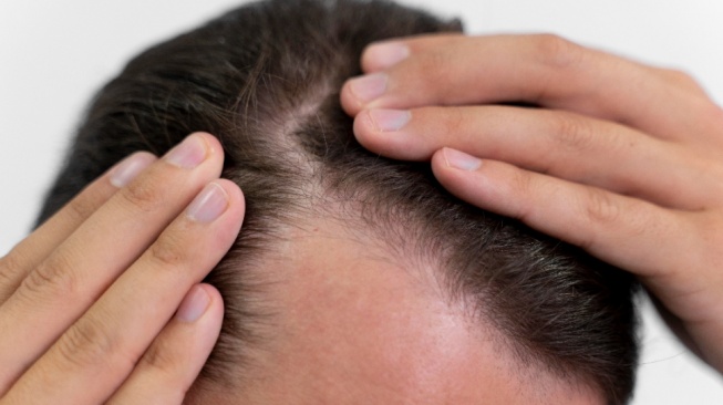 3 Rekomendasi Shampo Terbaik untuk Mengatasi Hairline Mundur: Rambut Tebal, Rontok Berkurang