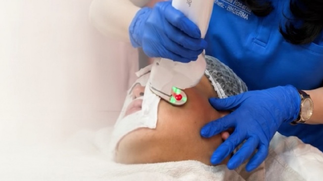 Jerawat Tak Lagi Hanya Diobati dari Permukaan, Teknologi Laser Kini Sasar Sumber Masalahnya (Dok. Istimewa)