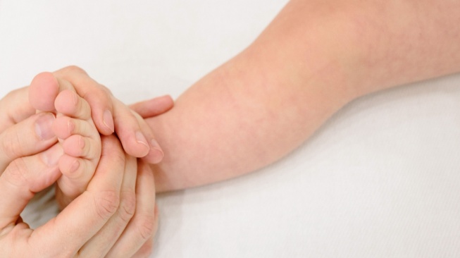 Kasus Dermatitis pada Bayi dan Anak Terus Meningkat, Ini Cara Cegah Eksim Si Kecil Kambuh