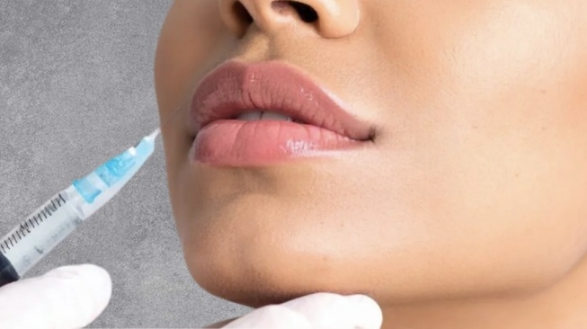 Natural Look Jadi Tren Baru, Ini yang Harus Diperhatikan Sebelum Melakukan Filler Modern