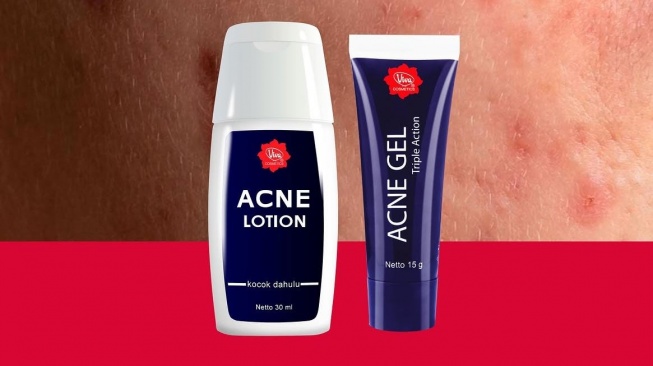 Beda Acne Lotion dan Acne Gel Viva, Kenali Fungsi serta Cara Pakainya sebelum Beli