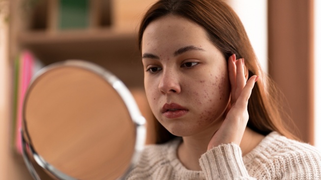 Moisturizer Apa yang Bisa Menghilangkan Bruntusan? Ini 9 Rekomendasinya