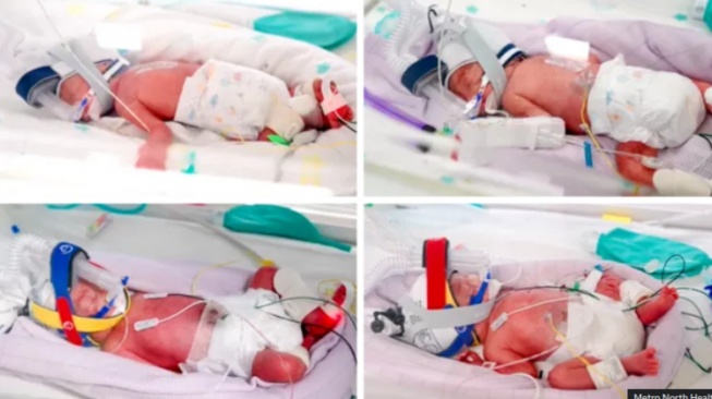 Seorang ibu di Australia berhasil melahirkan bayi kembar empat identik alami yang sangat langka. (BBC)