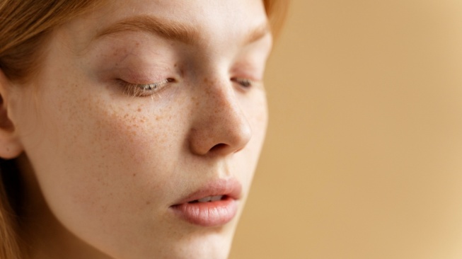 Sering Dianggap Sama, Ini 5 Perbedaan Freckles Alami vs Sunspots Flek Penuaan