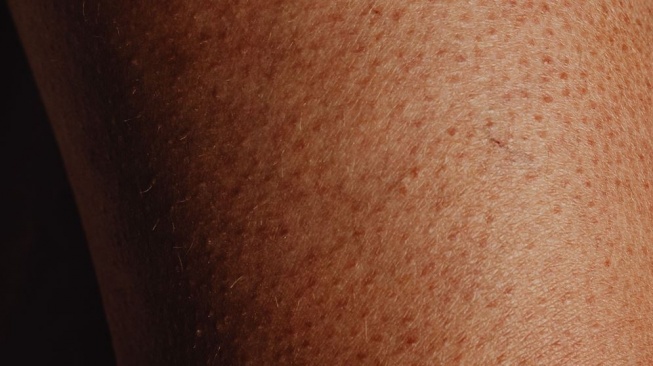 Strawberry Skin atau Chicken Skin. (Pexels/Karola G)