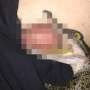 Duh, Testis Lelaki Ini Digigit Anak Buaya