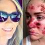 Ini Akibatnya Bila Sering "Tanning Bed"