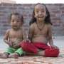 'Benjamin Button' di Dunia Nyata Ada di India