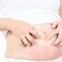 Sering Dikira Sama, Ketahui Perbedaan Stretch Mark dan Selulit