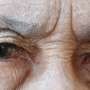Infeksi Langka, Cacing Parasit Bersarang di Mata Wanita Ini