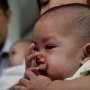 Pemisahan Bayi Kembar Siam Dempet Dada Libatkan 70 Dokter