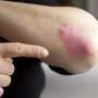 Meski Sulit Disembuhkan, Psoriasis Tak Menular
