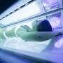 Terlalu Sering Pakai Sunbed, Wajah Perempuan Ini Berlubang