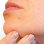 Cara Ampuh Mengatasi Jerawat Hormonal, Coba Minum Pil KB