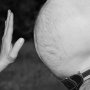 Perut Buncit Dikira Sering Ngebir, Ternyata Ada Tumor 13 Kg