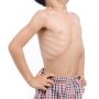 Beban Ganda Malnutrisi Bikin Anak Indonesia Tumbuh Pendek dan Kurus
