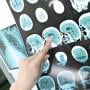 Peneliti Inggris: Pemindaian Stroke Bisa Jadi Cara Lain Deteksi Covid-19: