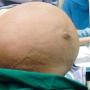 Tumor Raksasa Seberat 28 Kg Tumbuh di Rahim Perempuan Singapura
