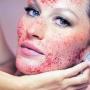 Vampire Facial Treatment  Kabarnya Bisa Picu HIV dan Hepatitis