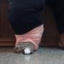 Kena Infeksi Kaki Gajah, Wanita Ini Tak Bisa Pakai Sepatu