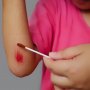 Penting, 5 Langkah Tepat Membersihkan Luka agar Tidak Infeksi