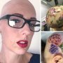 Sakit Autoimun, Perempuan Ini Tak Memiliki Sehelai Rambut di Seluruh Tubuh