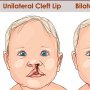 Kenali 5 Faktor Penyebab Bayi Lahir dengan Bibir Sumbing