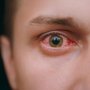 Perlu Tahu! Ini Penyebab Alergi Mata Dan Mata Merah, Serta Cara Mengatasinya