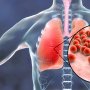 Punya Gejala Mirip, Ini Cara Membedakan Pneumonia dan Covid-19
