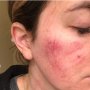 Facial karena Ingin Cantik, Wanita Ini Malah Alami Luka Bakar