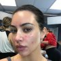 Begini Cara Kim Kardashian Tutupi Tampilan Psoriasis